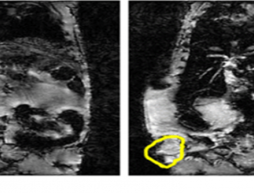 Imágenes de resonancia magnética nuclear que muestran la zona del tumor (rodeada por línea amarilla) antes de la inyección de las nanocápsulas, y después de su inyección y concentración magnética en el tumor, demostrando su presencia en las zonas oscurecidas del tumor